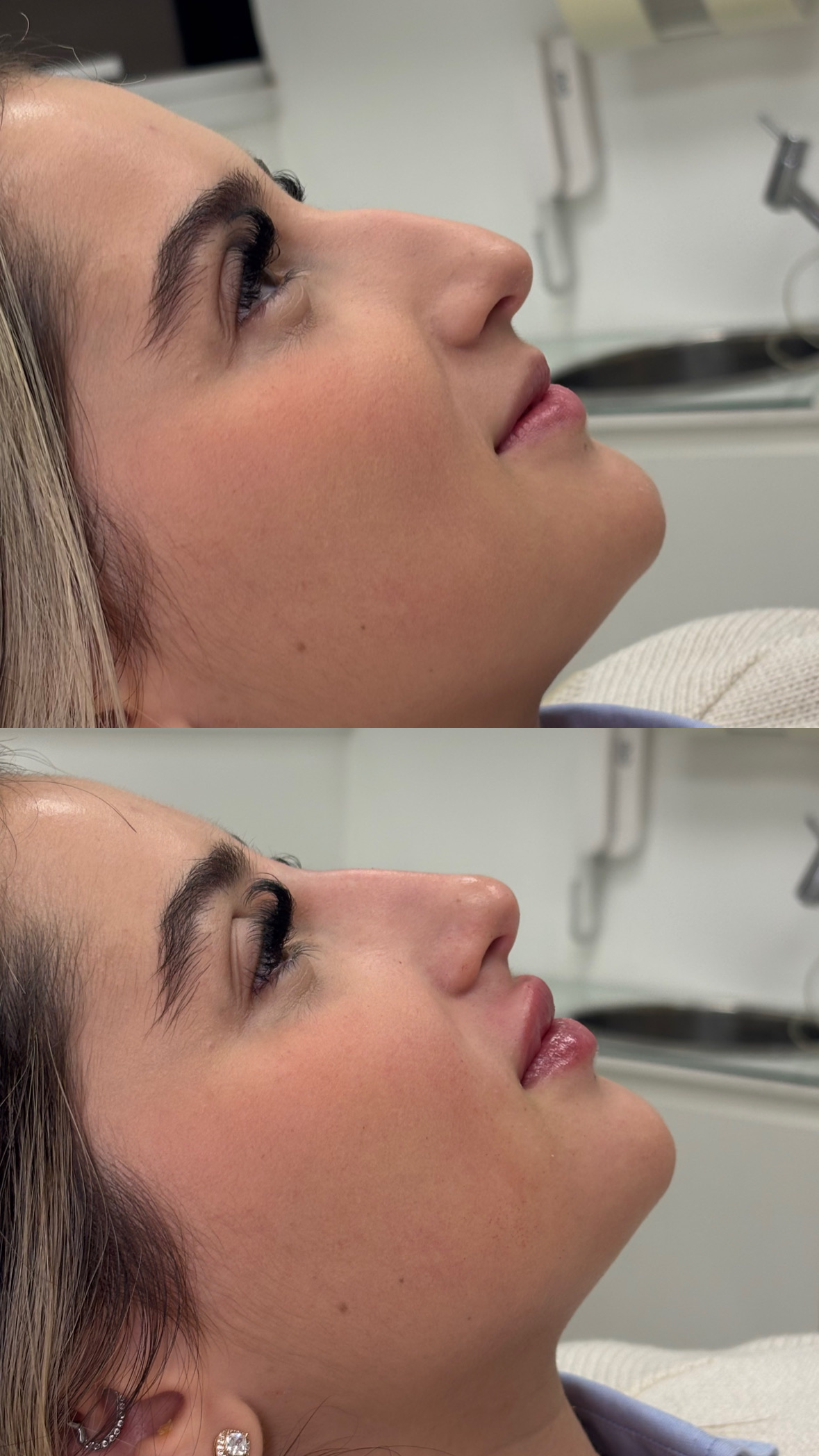Resultado de perfiloplastia — Dra. Tayana Domiciano