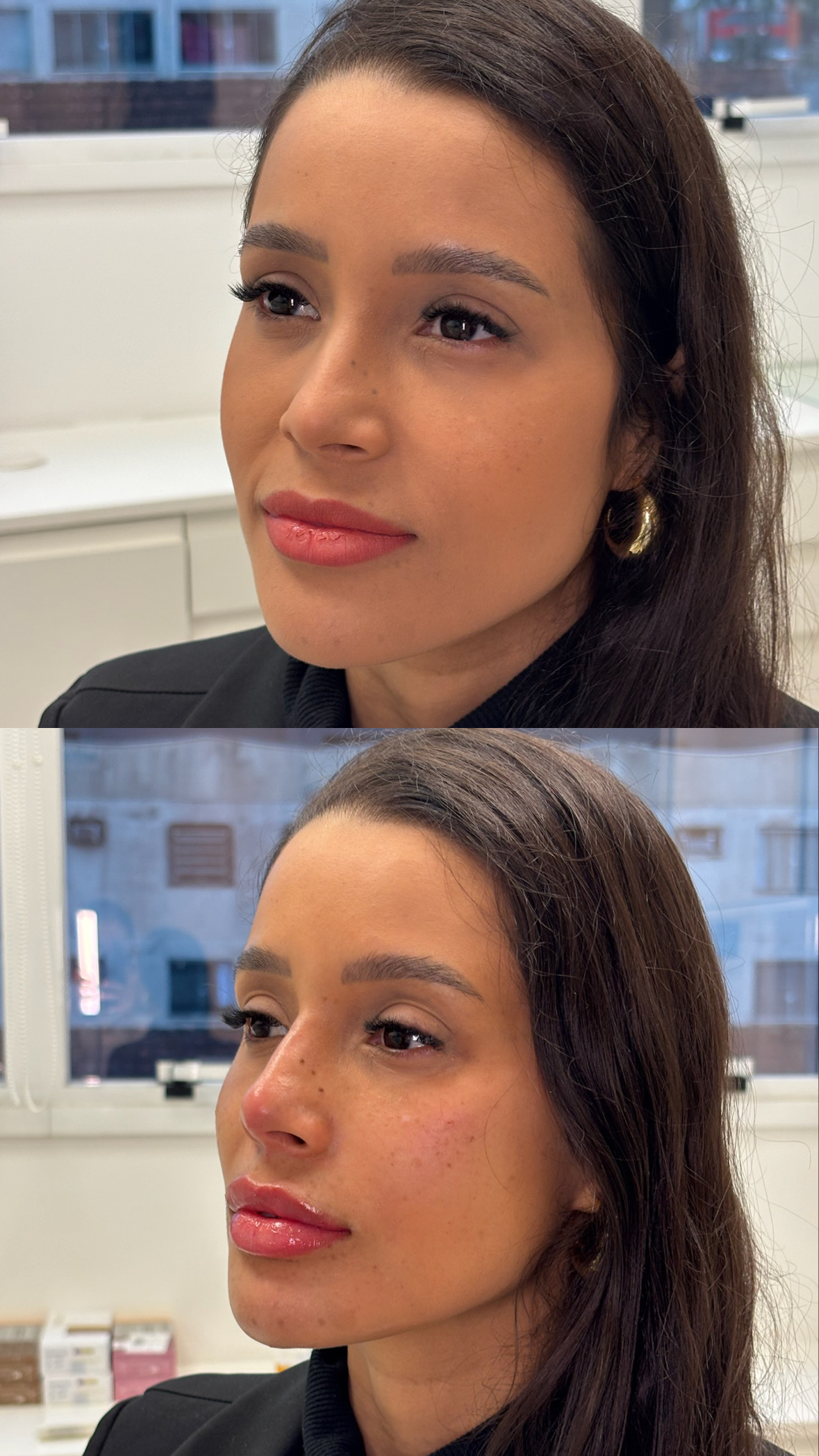Resultado de preenchimento full face — Dra. Tayana Domiciano