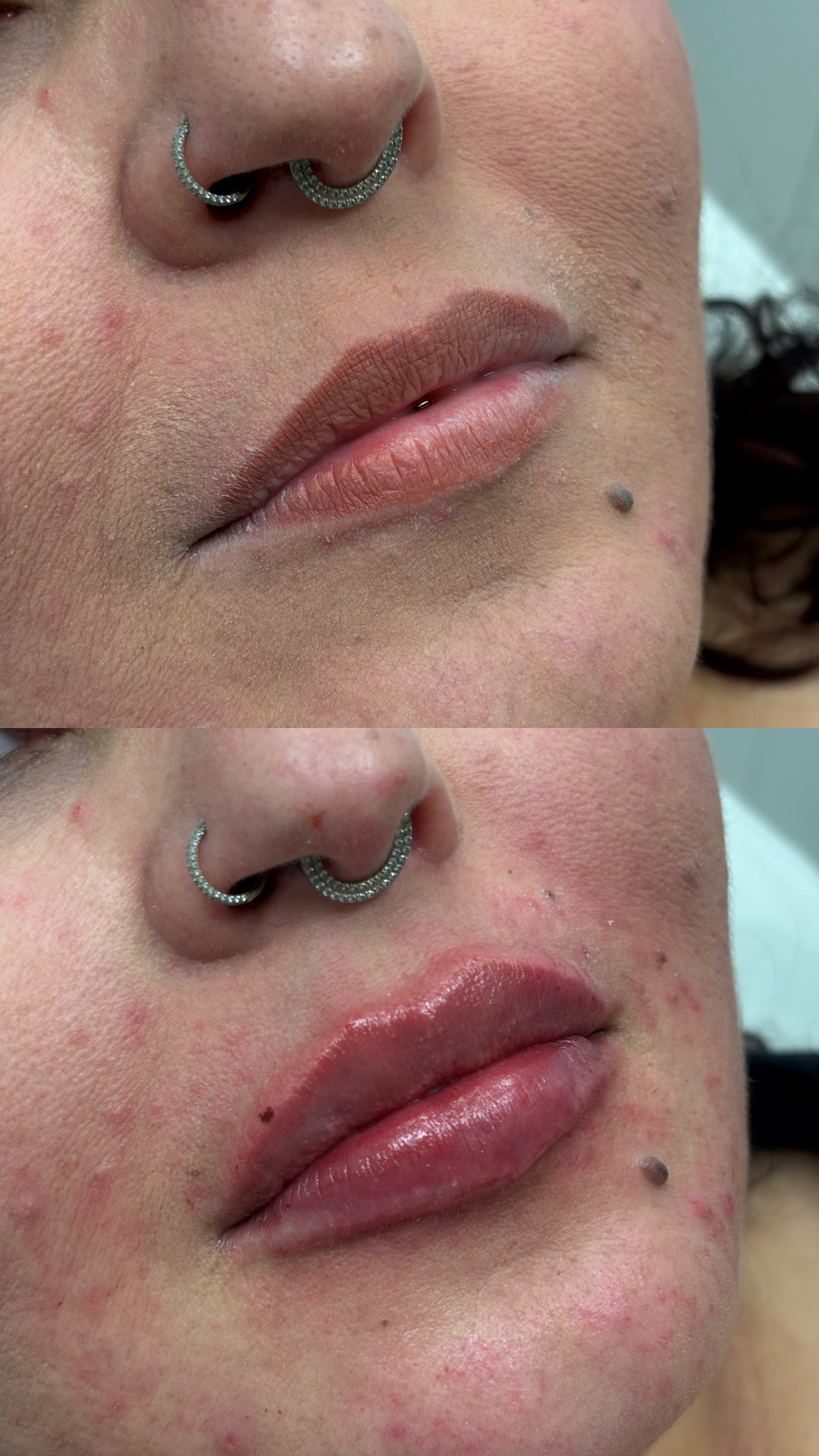 Resultado de preenchimento labial — Dra. Tayana Domiciano