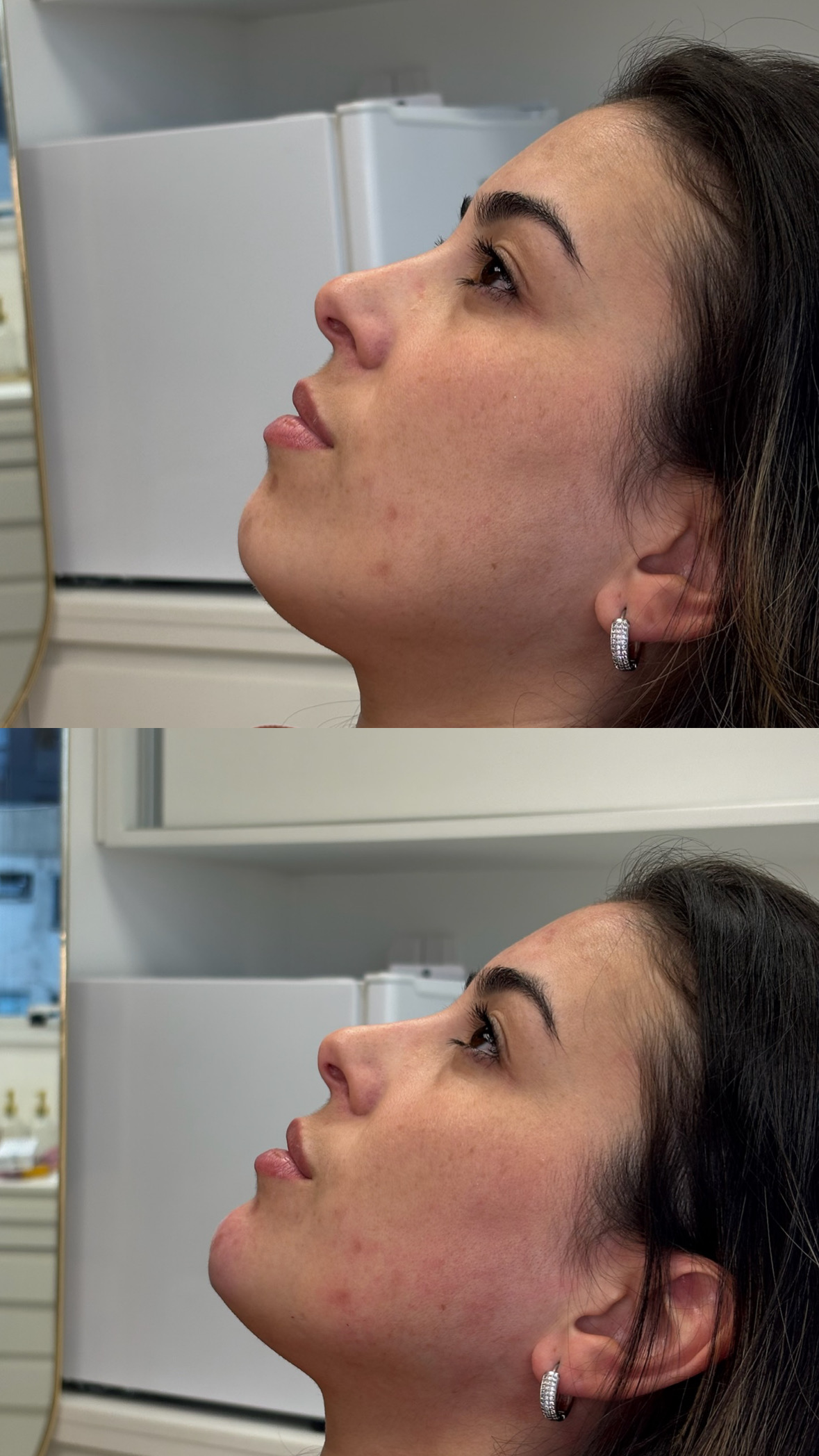 Resultado de preenchimento de mento — Dra. Tayana Domiciano