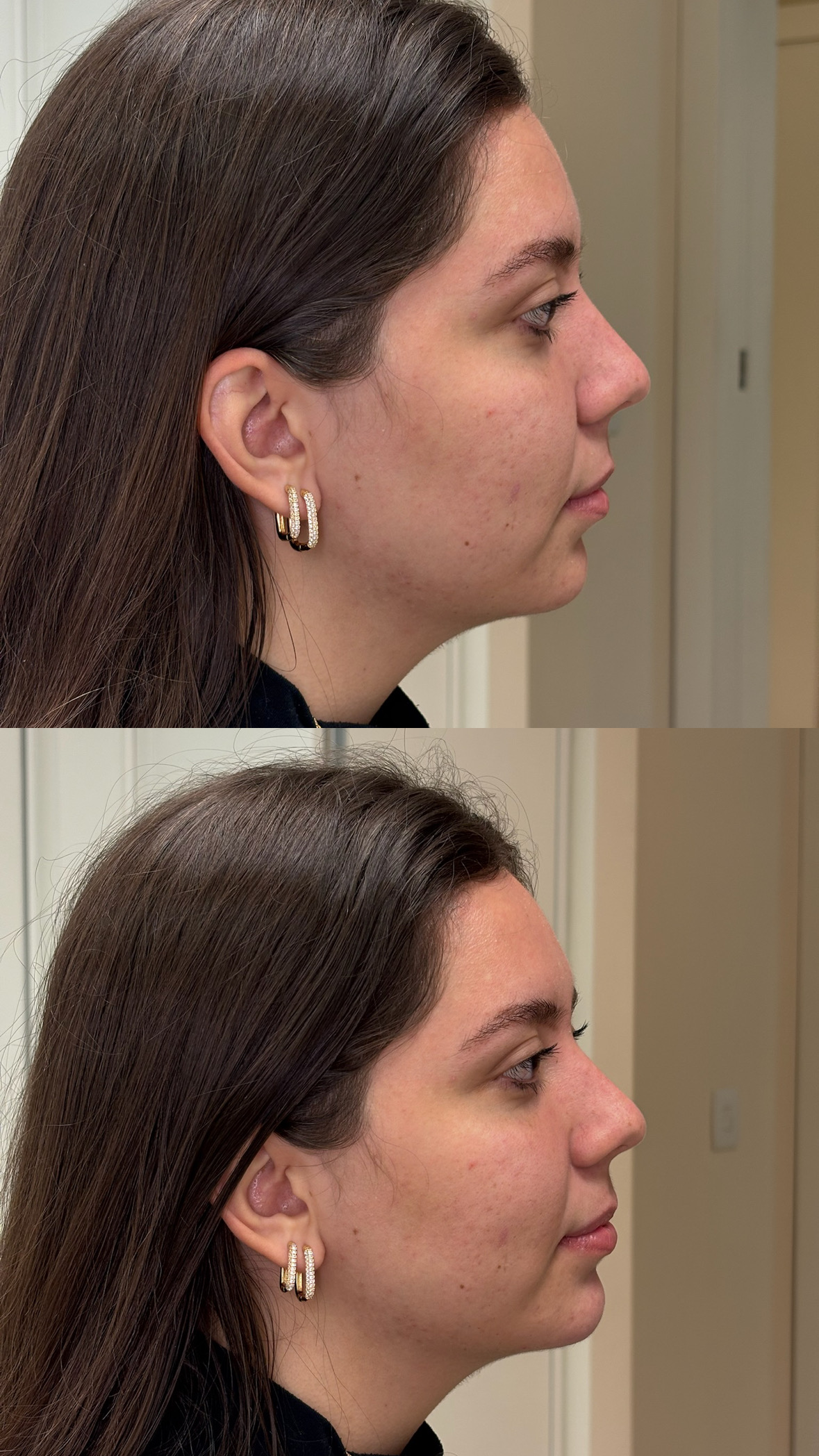 Resultado de preenchimento de mento — Dra. Tayana Domiciano